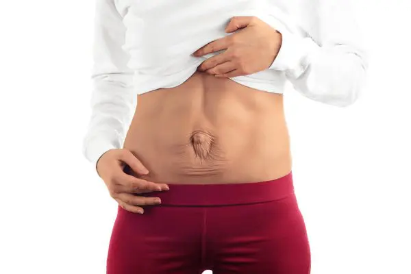 diastasis recti feature