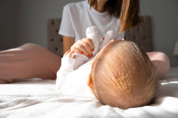  Everything You Need to Know About Cradle Cap